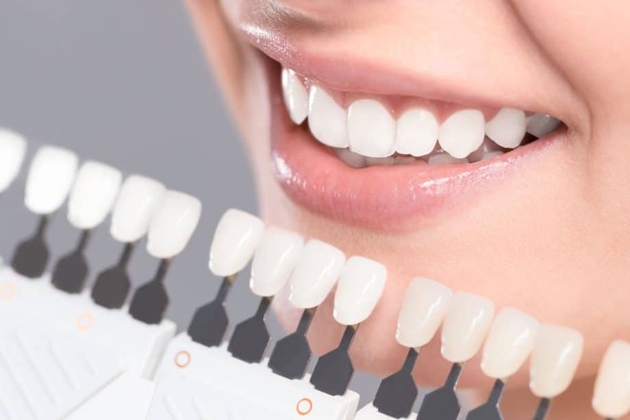 teeth being checked vs teeth whiteness scale