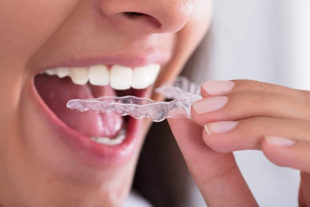 How to Get Invisalign Bridgeworks FDC Groton, CT